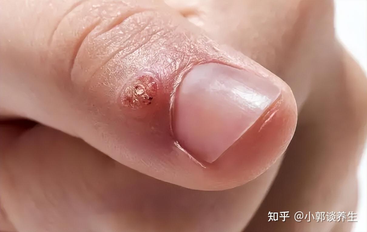 惊！8岁男孩泡温泉后手指感染HPV？家长崩溃，谁该为孩子的健康负责？